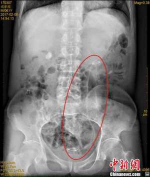 男子体内现导管长达30厘米 7年内一干重体力活会血尿时常出现腰部疼痛